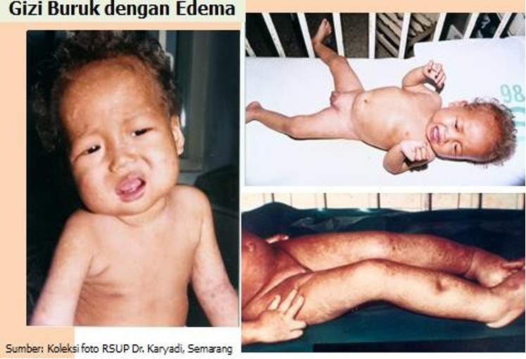 Anak Gizi Buruk dengan Edema (Kwashiorkor)