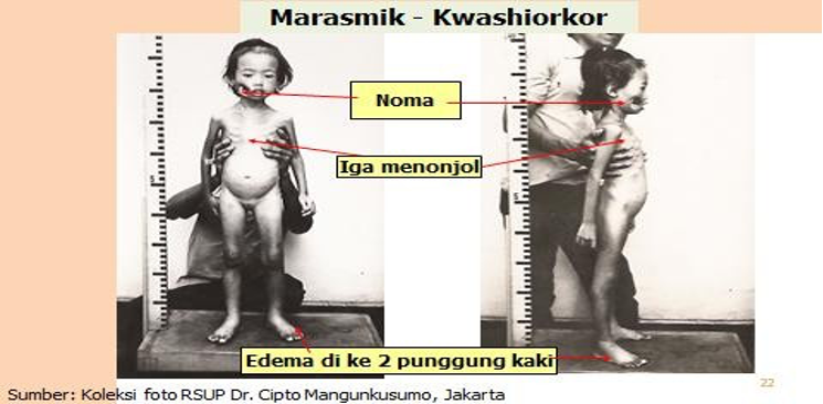 Anak Gizi Buruk Marasmik-Kwashiorkhor
