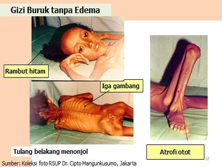 Anak Gizi Buruk Tanpa Edema (Marsmus)