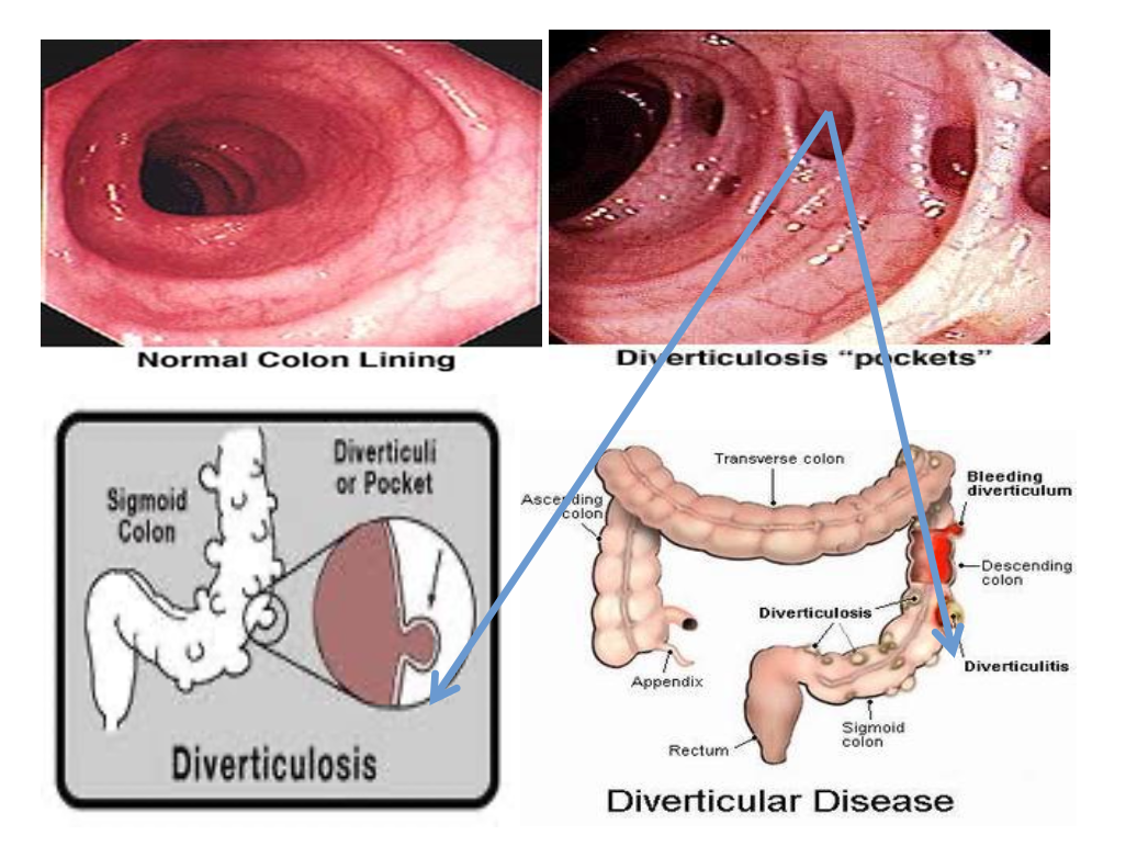 divertikulosis